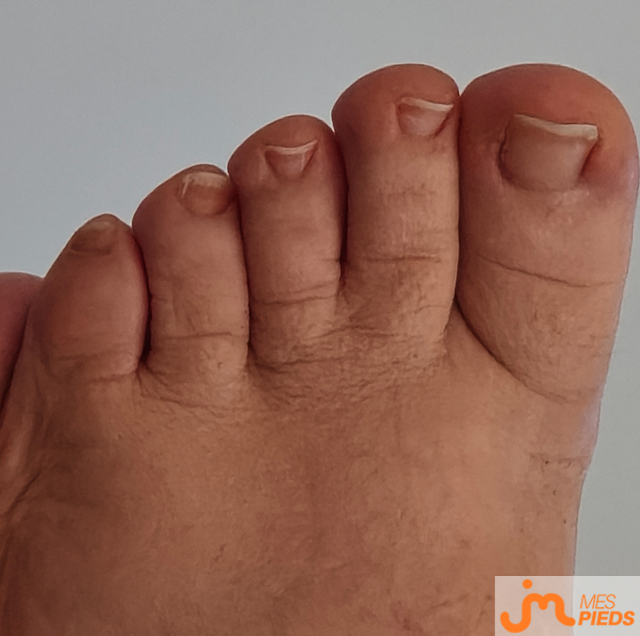 pieds de L&eacute;a2a